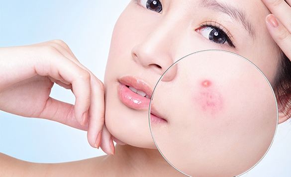 Tìm hiểu về các chất có khả năng gây mụn